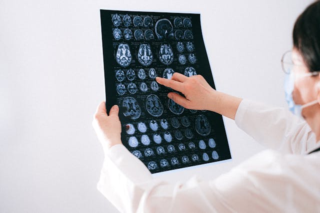 Entendiendo la Epilepsia: Causas, Tratamientos y Cómo Vivir con Ella